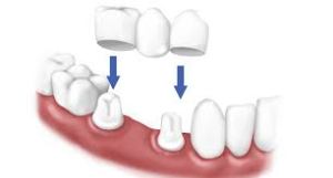 Dental crown to prevent further damage